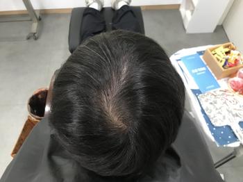 시술 전 머리