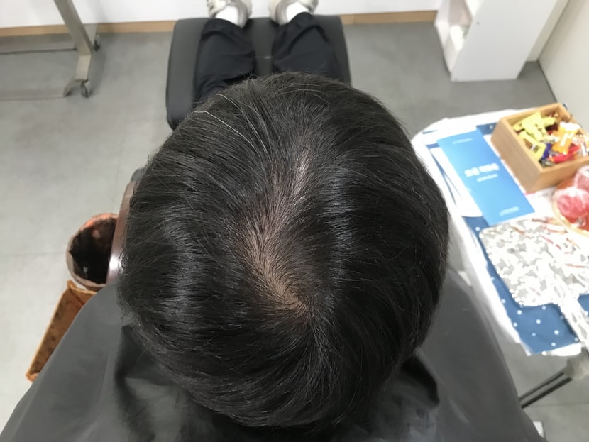 시술 전 머리