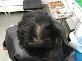 시술 전 