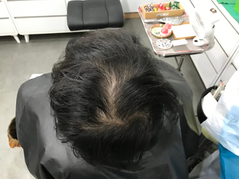 시술 전 