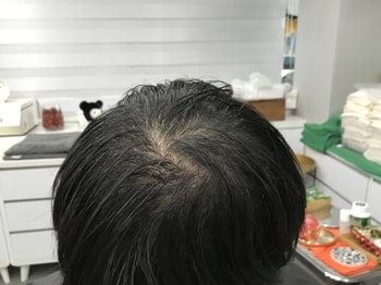 시술전