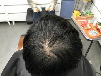 시술전 