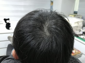 시술후