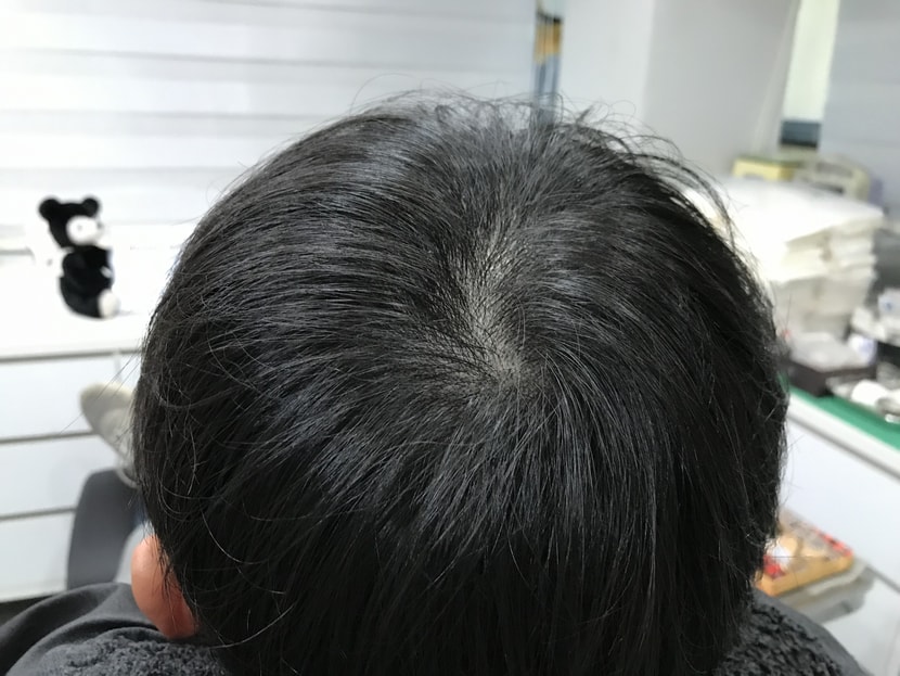 시술후
