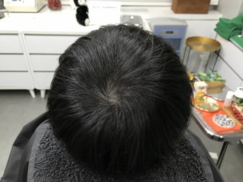 시술후