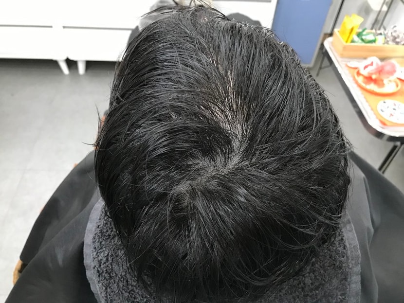 리터치후