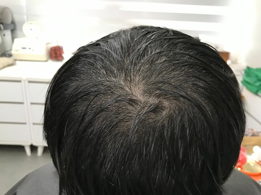 리터치전