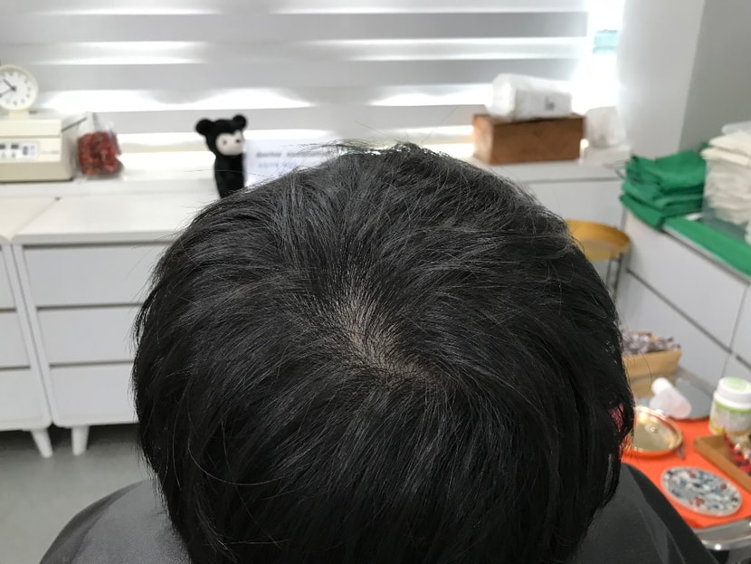 리터치전