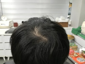 시술전