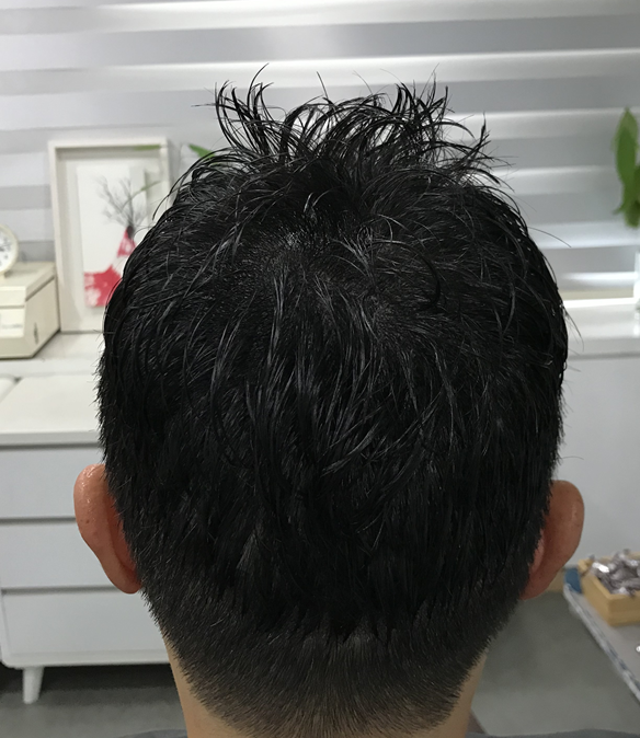 정수리 시술후