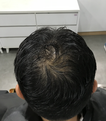 정수리 시술전
