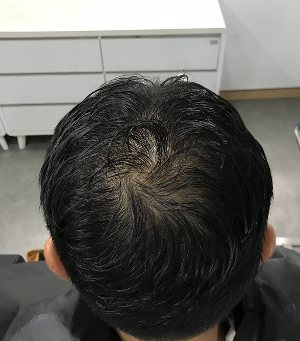 정수리 시술전