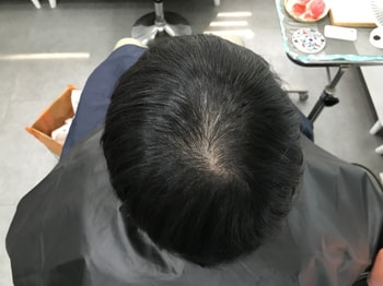 시술 전