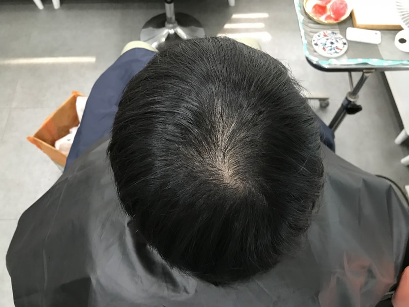 시술 전