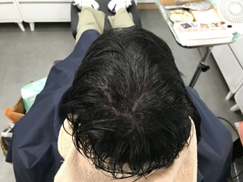 시술 후