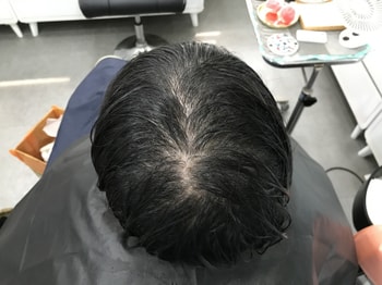 시술 전