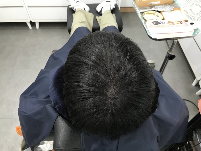 시술 후
