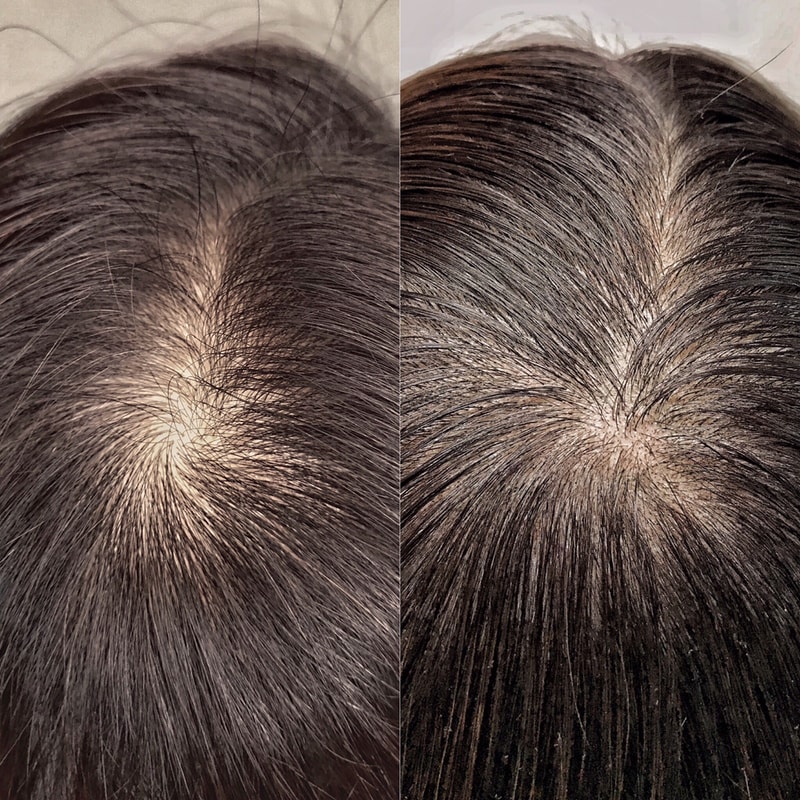 女性凹陷的头顶2次手术后记