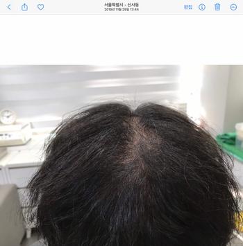 시술 전