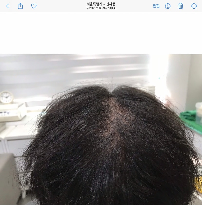 시술 전