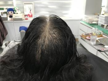 시술전 사진