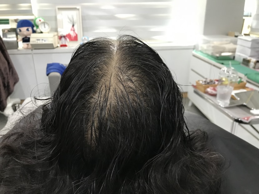 시술전 사진
