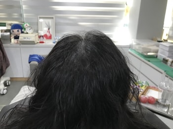 시술후 사진