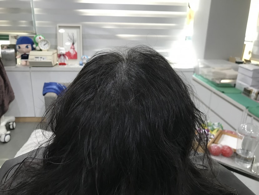 시술후 사진