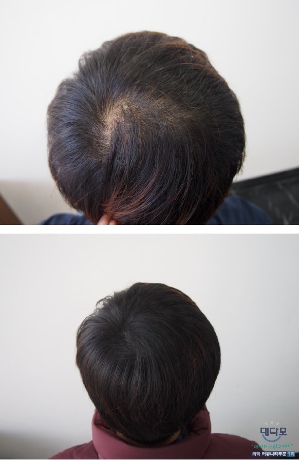 두피문신 1년 경과 후 사진입니다.