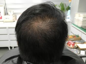 시술전