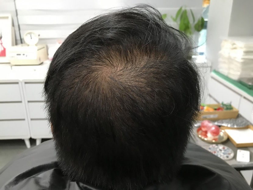 시술전