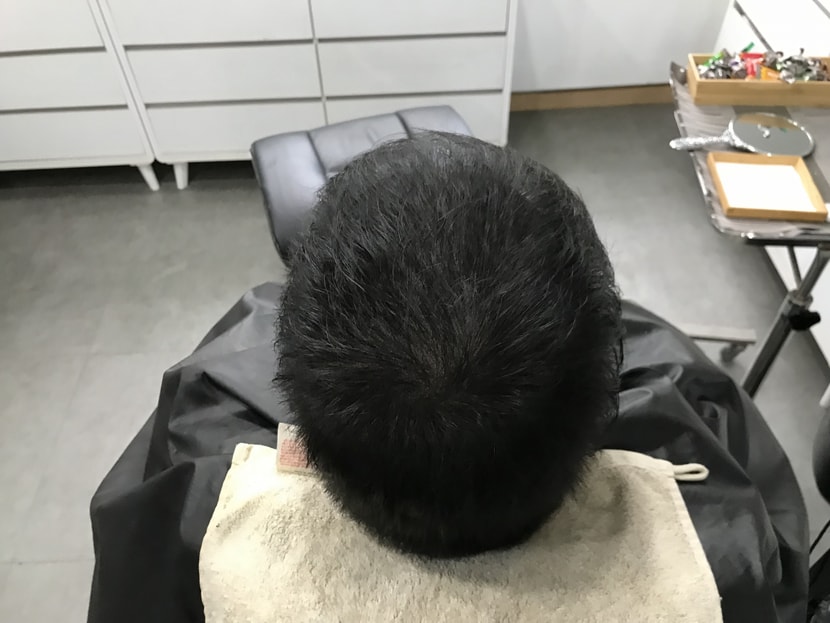 시술후