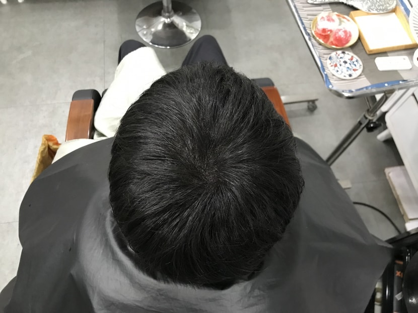 시술후