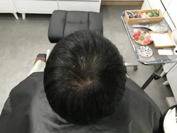 시술전