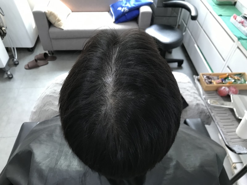 [ヨンセミダイン]頭皮のタトゥー体験談です。