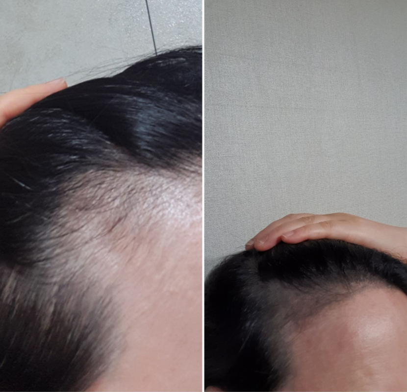 이건 헤어라인쪽인데 조명이 그래서 그런가 좀 어둡게 나왓는데 실제로는 더 자연스러워요