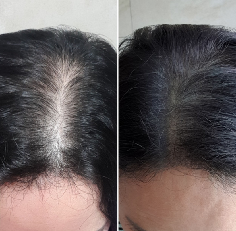 앞쪽전체가 모발이 너무없어서 전체다 받았구 집에서 한번찍어봣어요 가르마 방향은 좀 바꼇네요 근데 어짜피 전체적으로 다해서 가르마 바껴도 상관없어요 ㅎ