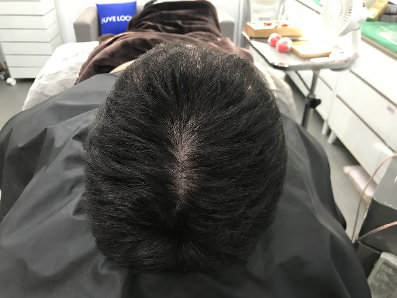 [연세미다인] 두피문신 1차 후기