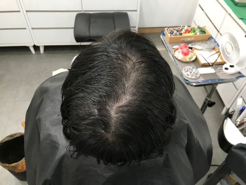 渐变头皮纹身1次后期