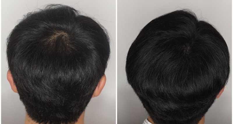 Review of successful scalp tattoos