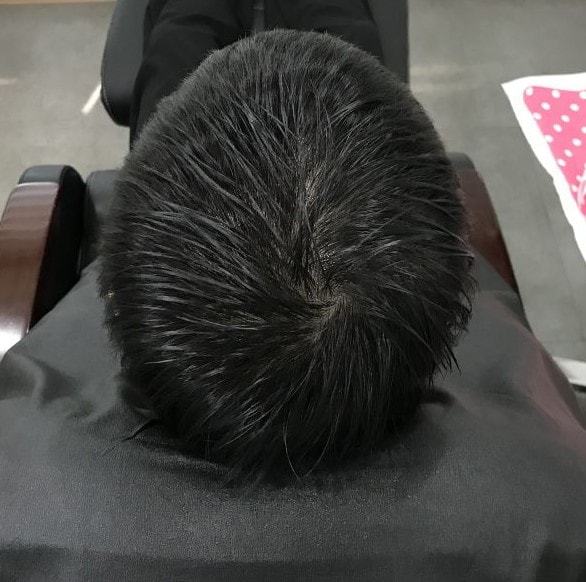 2차시술전