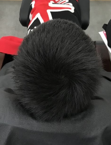 1차시술후