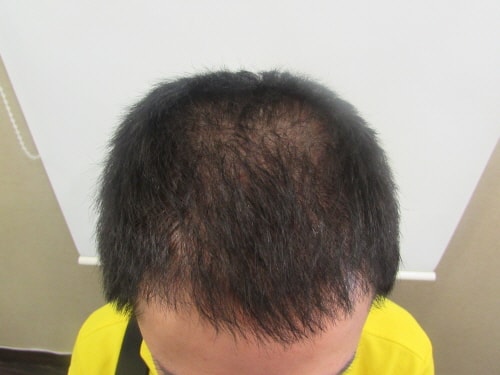 두피문신후기올립니다.