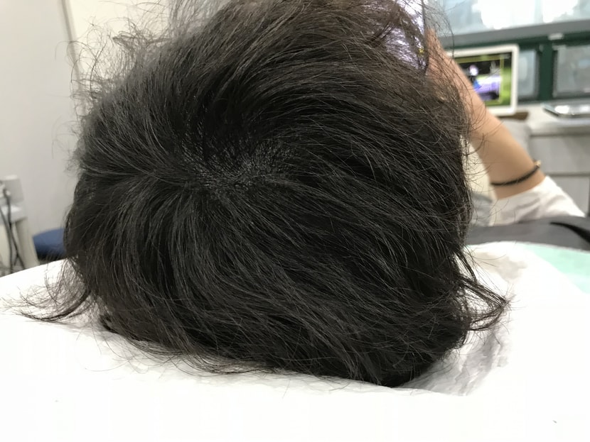 시술후 말랐을때
