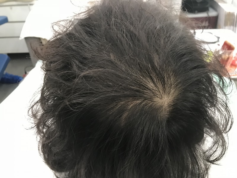 2년간 고민하다 연세미다인에서 투톤그물기법으로 했어요