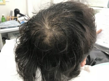 시술전 젖었을때
