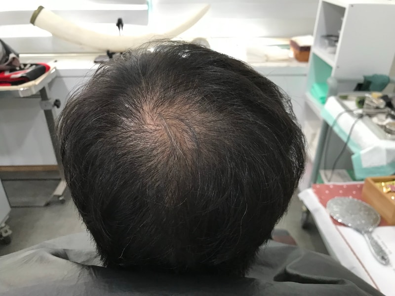 这是头皮纹身后记