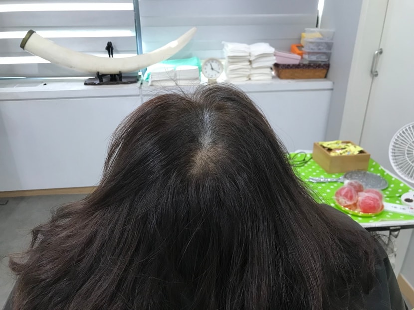 2차 시술후
