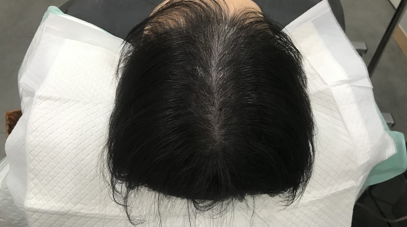 전두부 리터치 1회차입니다.