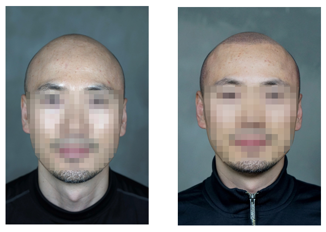 4th completion of bald scalp tattoo. Photo review summary